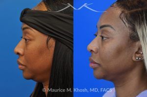 Photo of a patient before and after a procedure. Rhinoplasty to narrow nostrils and bridge of nose, neck liposuction - before and after results.