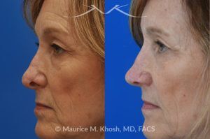 Photo of a patient before and after a procedure. Secondary repair of nostril retraction after attempted Mohs repair of the lower nose - This lovely 60 year-old had undergone repair of Mohs cancer removal from the left lower nose, by another surgeon. Unfortunately, this resulted in severe retraction of the left nostril and an unacceptable nasal deformity. 
Rhinoplasty to address nostril retraction was performed in Manhattan. Cartilage graft to the left nostril and composite graft (combination of skin and cartilage graft) to the inside edge of the nostril, helped to restore normality to the nose. The post op pictures are 6 months following her rhinoplasty.