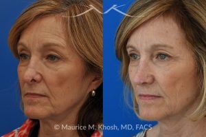 Photo of a patient before and after a procedure. Secondary repair of nostril retraction after attempted Mohs repair of the lower nose - This lovely 60 year-old had undergone repair of Mohs cancer removal from the left lower nose, by another surgeon. Unfortunately, this resulted in severe retraction of the left nostril and an unacceptable nasal deformity. 
Rhinoplasty to address nostril retraction was performed in Manhattan. Cartilage graft to the left nostril and composite graft (combination of skin and cartilage graft) to the inside edge of the nostril, helped to restore normality to the nose. The post op pictures are 6 months following her rhinoplasty.