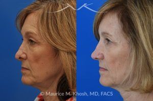 Photo of a patient before and after a procedure. Secondary repair of nostril retraction after attempted Mohs repair of the lower nose - This lovely 60 year-old had undergone repair of Mohs cancer removal from the left lower nose, by another surgeon. Unfortunately, this resulted in severe retraction of the left nostril and an unacceptable nasal deformity. 
Rhinoplasty to address nostril retraction was performed in Manhattan. Cartilage graft to the left nostril and composite graft (combination of skin and cartilage graft) to the inside edge of the nostril, helped to restore normality to the nose. The post op pictures are 6 months following her rhinoplasty.