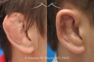 Photo of a patient before and after a procedure. Repair of Cauliflower Ear Deformity, Wrestler's Ear Deformity - before-and-after composite photo.