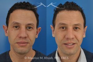 Photo of a patient before and after a procedure. Ear Pinning (Otoplasty) - for over projected large ears.