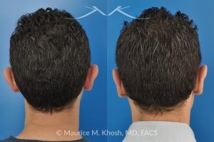Photo of a patient before and after a procedure. Ear Pinning (Otoplasty) - for over projected large ears.
