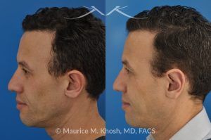 Photo of a patient before and after a procedure. Ear Pinning (Otoplasty) - for over projected large ears.