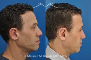 Photo of a patient before and after a procedure. Ear Pinning (Otoplasty) - for over projected large ears.