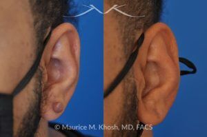 Photo of a patient before and after a procedure. Left Earlobe Keloid Removal with Invisible Scar - This 38 year-old underwent excision of a left earlobe keloid. The post op pictures show an imperceptible scar after keloid removal.
