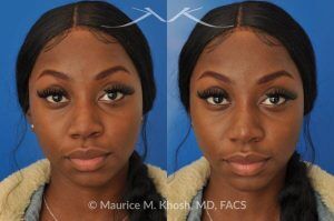 Photo of a patient before and after a procedure. Liquid rhinoplasty - This delightful patient was interested in improving the appearance of her nose without surgery. She disliked the droopy tip which became even more droopy when she smiled. She wanted more definition in the tip. Filler injections allowed us to improve the nasal tip position and shape, while a small injection into the bridge of the nose helped to eliminate the small hump. The patient was ecstatic with the results of her liquid rhinoplasty. 