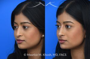 Photo of a patient before and after a procedure. Liquid rhinoplasty - This delightful patient was interested in smoothing a nasal hump and elevating and enhancing her droopy nasal tip. Less than 1 cc of filler was used to achieve these results.