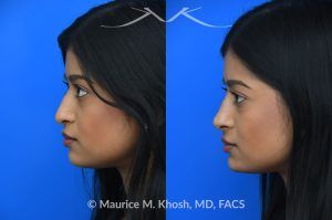 Photo of a patient before and after a procedure. Liquid rhinoplasty - This delightful patient was interested in smoothing a nasal hump and elevating and enhancing her droopy nasal tip. Less than 1 cc of filler was used to achieve these results.