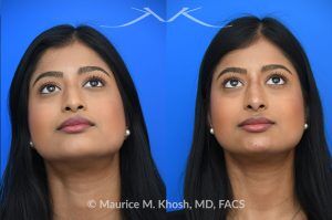 Photo of a patient before and after a procedure. Liquid rhinoplasty - This delightful patient was interested in smoothing a nasal hump and elevating and enhancing her droopy nasal tip. Less than 1 cc of filler was used to achieve these results.