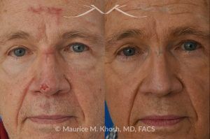 Photo of a patient before and after a procedure. Secondary repair of nasal tip defect following Mohs excision of skin cancer - This 76 year old had undergone excision of a basal cell cancer from the tip of his nose. He was dismayed at the highly visible depressed scar in his tip. Local tissue advancement flaps, followed by a series of microneedling treatments helped to restore his nasal tip to a normal appearance.