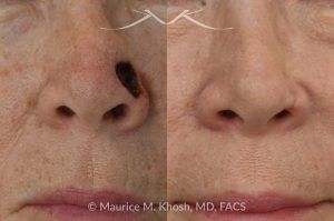Photo of a patient before and after a procedure. Mohs repair of lower nose - before and after photos.