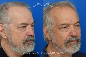 Photo of a patient before and after a procedure. Osteoma - before-and-after composite photo.