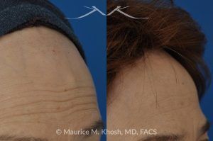 Photo of a patient before and after a procedure. Surgical Removal of Forehead Bony Hump - before-and-after composite photo.