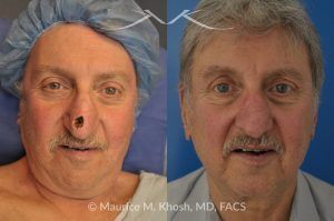 Photo of a patient before and after a procedure. Repair of Moh's defect of the lower nose after removal of basal cell cancer of skin. Bilobed flap technique - before and after photos.