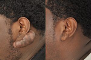 Photo of a patient before and after a procedure. Treatment of a Very Large Ear Keloid - One year post op result.