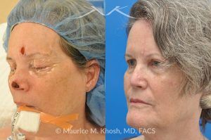 Photo of a patient before and after a procedure. Mohs reconstruction of nose - before and after photos.