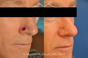 Photo of a patient before and after a procedure. Moh's defect of the nose repair - before and after photos.