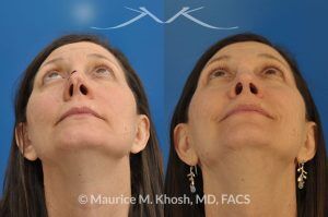 Photo of a patient before and after a procedure. Nose reconstruction - Rhinoplasty for Mos skin defect of nose after skin cancer removal.