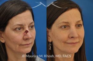 Photo of a patient before and after a procedure. Nose reconstruction - Rhinoplasty for Mohs skin defect of nose after skin cancer removal.