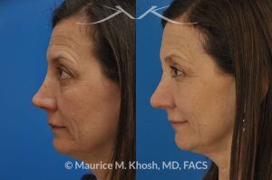 Photo of a patient before and after a procedure. Nose reconstruction - Rhinoplasty for Mohs skin defect of nose after skin cancer removal.