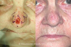 Photo of a patient before and after a procedure. Nose tip Mohs skin cancer reconstruction - before and after photos.