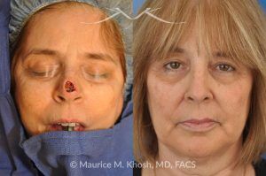 Photo of a patient before and after a procedure. Nose tip reconstruction Mohs skin cancer defect - before and after photos.