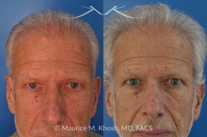 Photo of a patient before and after a procedure. Enlarging Hard Mass in Left Upper Forehead - This 65 year old who had noted a progressively enlarging hard mass in the left upper forehead. The clinical examination finding was consistent with an osteoma. The osteoma was successfully removed as an office procedure utilizing local anesthesia. The incision was perfectly hidden inside the hairline above the location of the osteom. The incision was designed to allow hair growth through the scar, thereby camouflaging it.