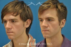 Photo of a patient before and after a procedure. Otoplasty - ear before and after correction.