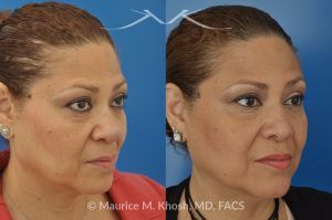 Photo of a patient before and after a procedure. Removal of skin cancer in the tip of the nose with repair - before and after photos.