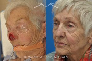 Photo of a patient before and after a procedure. Nose Mohs skin cancer repair, utilizing forehead flap and ear cartilage graft - before and after photos.