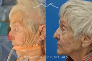 Photo of a patient before and after a procedure. Nose Mohs skin cancer repair, utilizing forehead flap and ear cartilage graft - before and after photos.
