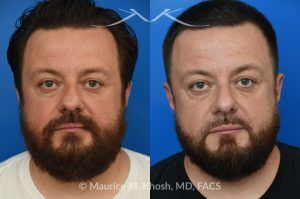 Photo of a patient before and after a procedure. Functional & Cosmetic Septo-Rhinoplasty with Nasal Valve Repair - This gentleman suffered from chronic nasal obstruction, which worsened with exercise, and his right nostril collapsed during deep inhalation. His nasal bridge was deviated to the left, and the tip was bulbous. A septo-rhinoplasty was performed to correct these issues. A deviated septum was repaired, and a right-sided spreader graft was used to straighten the nasal bridge. Nostril collapse was corrected with a combination of cephalic trimming of the alar cartilages and alar strut grafts, which also improved the cosmetic appearance of the nasal tip.