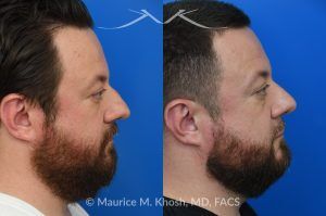 Photo of a patient before and after a procedure. Functional & Cosmetic Septo-Rhinoplasty with Nasal Valve Repair - This gentleman suffered from chronic nasal obstruction, which worsened with exercise, and his right nostril collapsed during deep inhalation. His nasal bridge was deviated to the left, and the tip was bulbous. A septo-rhinoplasty was performed to correct these issues. A deviated septum was repaired, and a right-sided spreader graft was used to straighten the nasal bridge. Nostril collapse was corrected with a combination of cephalic trimming of the alar cartilages and alar strut grafts, which also improved the cosmetic appearance of the nasal tip.