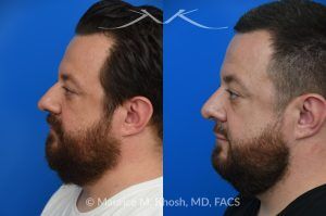 Photo of a patient before and after a procedure. Functional & Cosmetic Septo-Rhinoplasty with Nasal Valve Repair - This gentleman suffered from chronic nasal obstruction, which worsened with exercise, and his right nostril collapsed during deep inhalation. His nasal bridge was deviated to the left, and the tip was bulbous. A septo-rhinoplasty was performed to correct these issues. A deviated septum was repaired, and a right-sided spreader graft was used to straighten the nasal bridge. Nostril collapse was corrected with a combination of cephalic trimming of the alar cartilages and alar strut grafts, which also improved the cosmetic appearance of the nasal tip.