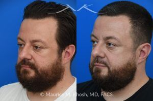 Photo of a patient before and after a procedure. Functional & Cosmetic Septo-Rhinoplasty with Nasal Valve Repair - This gentleman suffered from chronic nasal obstruction, which worsened with exercise, and his right nostril collapsed during deep inhalation. His nasal bridge was deviated to the left, and the tip was bulbous. A septo-rhinoplasty was performed to correct these issues. A deviated septum was repaired, and a right-sided spreader graft was used to straighten the nasal bridge. Nostril collapse was corrected with a combination of cephalic trimming of the alar cartilages and alar strut grafts, which also improved the cosmetic appearance of the nasal tip.