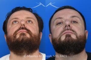 Photo of a patient before and after a procedure. Functional & Cosmetic Septo-Rhinoplasty with Nasal Valve Repair - This gentleman suffered from chronic nasal obstruction, which worsened with exercise, and his right nostril collapsed during deep inhalation. His nasal bridge was deviated to the left, and the tip was bulbous. A septo-rhinoplasty was performed to correct these issues. A deviated septum was repaired, and a right-sided spreader graft was used to straighten the nasal bridge. Nostril collapse was corrected with a combination of cephalic trimming of the alar cartilages and alar strut grafts, which also improved the cosmetic appearance of the nasal tip.