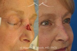Photo of a patient before and after a procedure. Repair of Moh's skin cancer defect of nose - Reconstruction of nose after basal cell cancer excision.