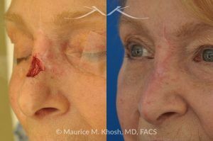 Photo of a patient before and after a procedure. Repair of Moh's skin cancer defect of nose - Reconstruction of nose after basal cell cancer excision.