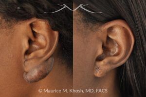 Photo of a patient before and after a procedure. Keloid Ear - before and after treatment results.