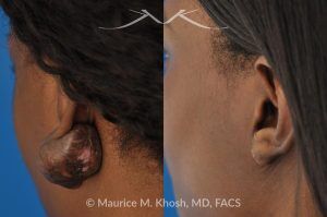Photo of a patient before and after a procedure. Keloid Ear - before and after treatment results.