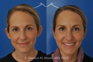 Photo of a patient before and after a procedure. Bilateral Otoplasty to Correct Protruding Ears and Improve Symmetry - This delightful 34 year old wanted to improve her protuberant ears. The left ear stuck out more than the right side. Otoplasty or ear pinning surgery was done in our office in Manhattan, under local anesthesia. Both ears were pushed back to a natural position. Symmetry between the position of two ears was achieved. 