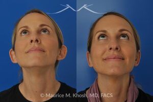 Photo of a patient before and after a procedure. Bilateral Otoplasty to Correct Protruding Ears and Improve Symmetry - This delightful 34 year old wanted to improve her protuberant ears. The left ear stuck out more than the right side. Otoplasty or ear pinning surgery was done in our office in Manhattan, under local anesthesia. Both ears were pushed back to a natural position. Symmetry between the position of two ears was achieved. 