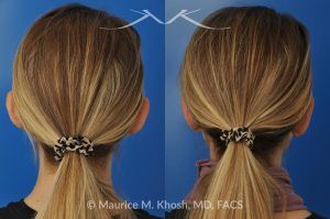 Photo of a patient before and after a procedure. Bilateral Otoplasty to Correct Protruding Ears and Improve Symmetry - This delightful 34 year old wanted to improve her protuberant ears. The left ear stuck out more than the right side. Otoplasty or ear pinning surgery was done in our office in Manhattan, under local anesthesia. Both ears were pushed back to a natural position. Symmetry between the position of two ears was achieved. 