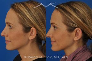Photo of a patient before and after a procedure. Bilateral Otoplasty to Correct Protruding Ears and Improve Symmetry - This delightful 34 year old wanted to improve her protuberant ears. The left ear stuck out more than the right side. Otoplasty or ear pinning surgery was done in our office in Manhattan, under local anesthesia. Both ears were pushed back to a natural position. Symmetry between the position of two ears was achieved. 