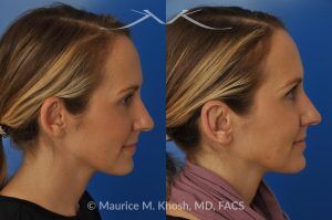 Photo of a patient before and after a procedure. Bilateral Otoplasty to Correct Protruding Ears and Improve Symmetry - This delightful 34 year old wanted to improve her protuberant ears. The left ear stuck out more than the right side. Otoplasty or ear pinning surgery was done in our office in Manhattan, under local anesthesia. Both ears were pushed back to a natural position. Symmetry between the position of two ears was achieved. 
