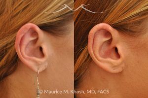 Photo of a patient before and after a procedure. Revision Otoplasty - before-and-after composite photo.