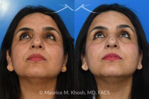 Photo of a patient before and after a procedure. Left Forehead Osteoma removal — No Visible Scar 1 - A large left sided upper forehead osteoma was removed through an invisible incision within the hairline. 