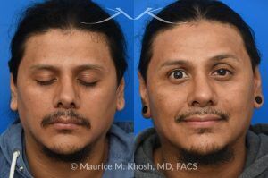 Photo of a patient before and after a procedure. Revision rhinoplasty and repair of nasal vestibular stenosis 1 - This patient previously sustained a nasal fracture that was treated with rhinoplasty. Unfortunately, the surgery did not resolve his breathing obstruction. The nasal bridge had been excessively lowered, creating a “ski-slope” profile, and the cartilaginous dorsum remained deviated to the left. During his revision rhinoplasty, the persistently deviated caudal septum was reconstructed with a strut graft, and the dorsal alignment and height were restored using a right sided spreader graft.  