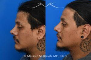 Photo of a patient before and after a procedure. Revision rhinoplasty and repair of nasal vestibular stenosis 1 - This patient previously sustained a nasal fracture that was treated with rhinoplasty. Unfortunately, the surgery did not resolve his breathing obstruction. The nasal bridge had been excessively lowered, creating a “ski-slope” profile, and the cartilaginous dorsum remained deviated to the left. During his revision rhinoplasty, the persistently deviated caudal septum was reconstructed with a strut graft, and the dorsal alignment and height were restored using a right sided spreader graft.  